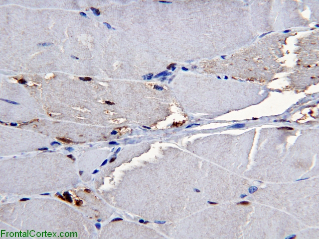 Inclusion body myositis, SMI-31 immunohistochemical staining x400